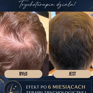 Efekt sześciomiesięcznej terapii trychologicznej🤩
U pacjenta wdrożono farmakoterapię, prawidłową pi