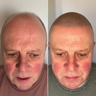 Scalp Micro-Pigmentation BEFORE and AFTER… 🤯

Head over to our website (https://www.thekiriclinic.c