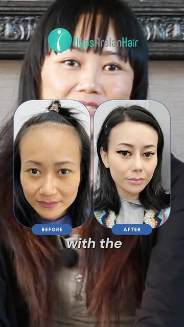 A new hair journey, and she’s loving the result!

“I’m very happy with my hair transplant result!” 
