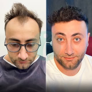 From bald to a fuller, more confident look!

From significant hair loss to visibly fuller coverage a
