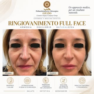 ✨ RINGIOVANIMENTO FULL FACE | PRIMA & DOPO

Il ringiovanimento del volto non significa modificarne i
