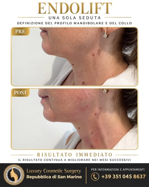Endolift del profilo mandibolare e del collo dopo una sola seduta. Endolift è un trattamento laser m