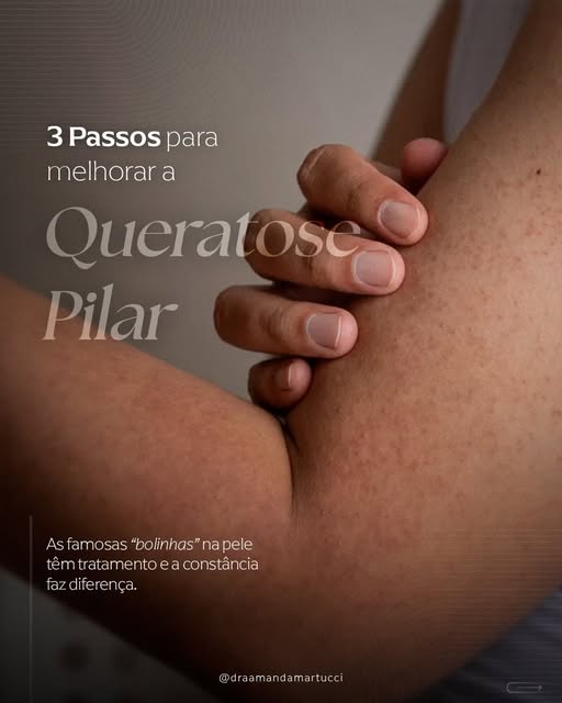A queratose pilar é uma condição que pode exigir manutenção. Por isso, se você tem essas “bolinhas” 