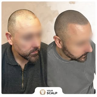 A clean, structured hairline can completely change the way the face is framed and David’s result is 
