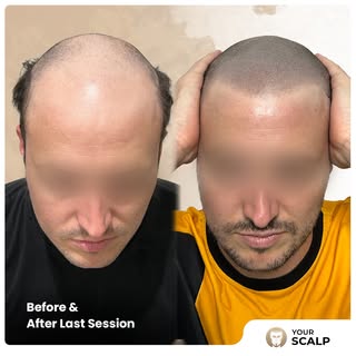 Theo visited us with a plan: build natural density with SMP before his hair transplant. ✨

Since he 