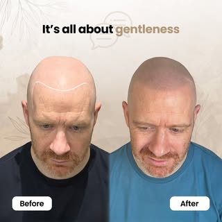 Why Natural SMP Is All About Restraint?

Good Scalp Micropigmentation should never draw attention to