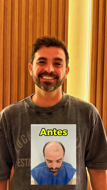 Se você tiver visto alguém que fez transplante capilar e não mudou nada, então é porque ele não fez 