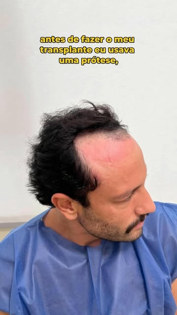 Paciente decidiu abandonar a prótese capilar!
Em pouco tempo, 6 meses de Transplante Capilar, nos en