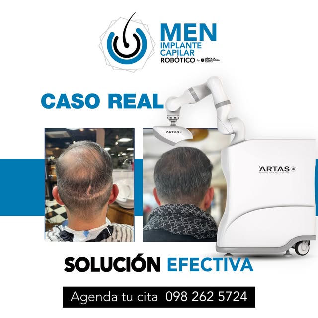 🧑‍⚕️ Precisión, planificación y tecnología para tu trasplante capilar.

El robot ARTAS ayuda al equ