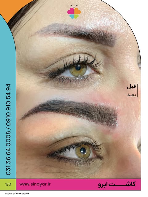 قبل و‌ بعد از کاشت ابرو…💉🧪
در کلینیک تخصصی سینایار

جهت اطلاع از قیمت کاشت ابرو کلمه ی (ابرو) را ک