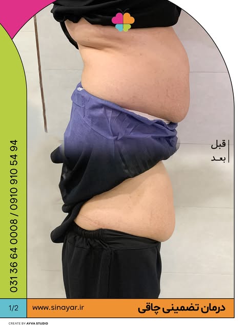 ⁨درمان تضمینی چاقی در کلینیک سینایار…🩺💉

جهت مشاوره و اطلاع از قیمت ها کلمه ی (لاغری) را کامنت کنی