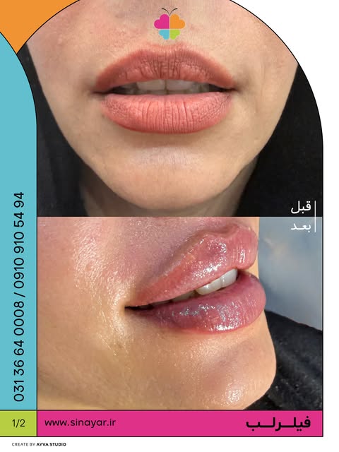 قبل و بعد از فیلر لب…👄💉
در کلینیک سینایار

جهت اطلاع از قیمت فیلر لب کلمه ی (لب) را کامنت کنید.

A