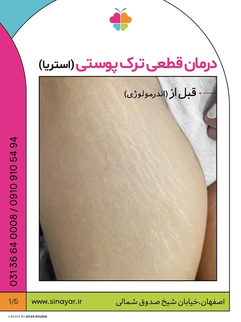 برای اولین بار در اصفهان؛
درمان قطعی ترک پوستی(استریا)

جهت اطلاعات بیشتر و قیمت کلمه ی (استریا) را 