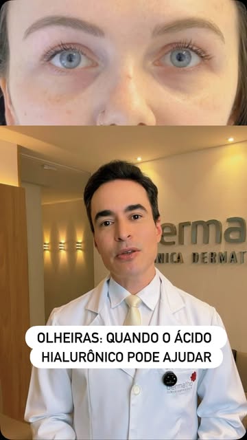 Olheiras não são todas iguais e o tratamento também não deve ser.

Quando a principal causa é a prof