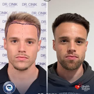 ✨ 3450 Grafts | DHI Hair Transplant | 9-Month Result

A natural-looking transformation designed to r