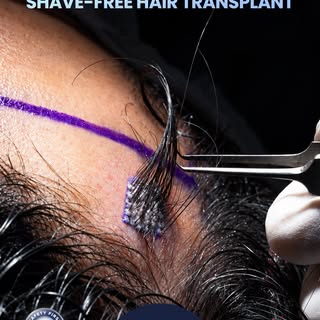 Wondering if you can get a hair transplant without shaving your head? Yes, you can! ✂️ Long Hair FUE