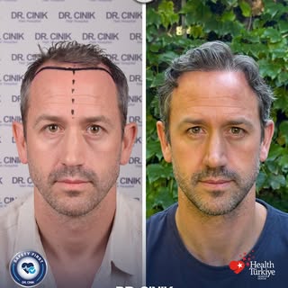 4,100 Grafts | DHI Hair Transplant | 9-Month Result

A natural-looking transformation focused on res