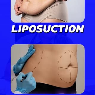 Mee body ki Liposuction VS Tummy Tuck, edi cheskovali??

Mee body condition evaluate chesukoni corre