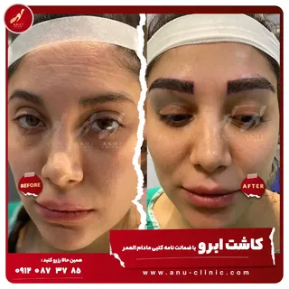 .
❤کاشت ابرو ی بی نظیر از کلینیک آنو ..👰‍♀️😍
.
| #پرپشت_فکر_کنید |
.
همین حالا رزرو کنید :
وبسایت 