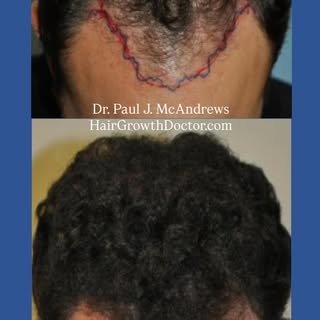 This “Before & After” successful hair transplant with only 1,600 grafts is an example of Dr. Paul J.