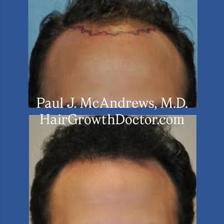 Bring your hair back to a fully natural and healthy look.

Dr. Paul J. McAndrews is the hair restora