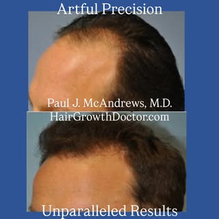 The best hair transplant doesn’t look like one at all. Dr. McAndrews achieves natural-looking hair t