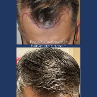 The McAndrews Method achieves 4 goals vital to a successful hair transplant:

✅ A result that’s as n