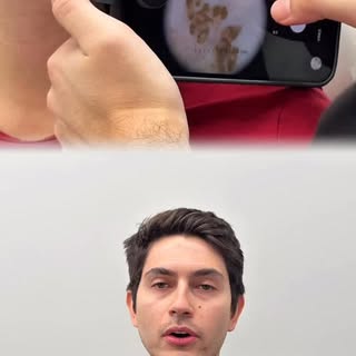 A cirurgia de nevo congênito (pintas presentes ao nascimento) é realizada principalmente por dois mo
