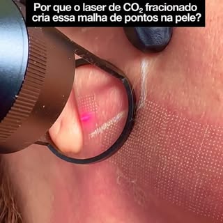 O laser de CO2 é chamado de fracionado porque ele não trata toda a superfície de forma contínua. O f