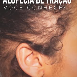 Alguns penteados parecem inofensivos, mas quando feitos com muita tração e frequência podem causar d