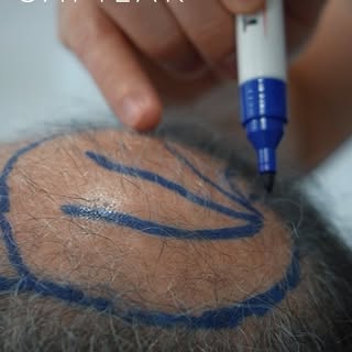 Se você estava esperando um sinal para cuidar da sua calvície, talvez seja esse! 

#transplantecapil
