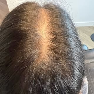 1st session on my amazing client! #smp #scalpmicropigmentation #arizona #hairtattoo #hairtransformat