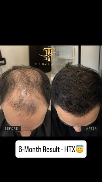 Call now for free consultation 713-253-9291

This transformation focused on zone 1, zone 2, zone 3 a