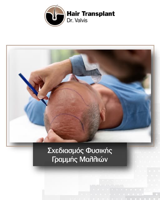🔹 Η φυσική γραμμή των μαλλιών αποτελεί ένα από τα σημαντικότερα στοιχεία μιας επιτυχημένης μεταμόσχ