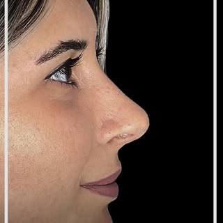 Our patient came in for post-op check after rhinoplasty operation.

Contact us for further informati