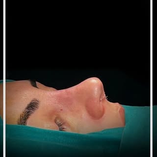 A refined and natural profile after rhinoplasty. ✨

Performed with talent and precision. Tailored to