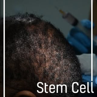 Transforming lives, one follicle at a time. 💫

Alopecia can be a difficult journey, but you don't h