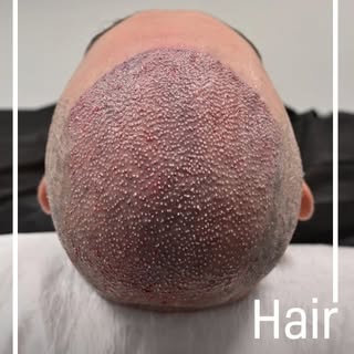 The journey from thinning hair to a full, dense look is truly life-changing, and a 5,000 grafts hair