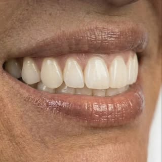 SMILE TRANSFORMATION | Gummy Smile Correction ✨

In this case, the main concern was excessive gingiv