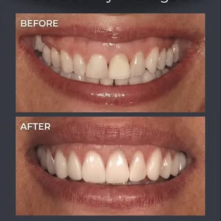 SMILE TRANSFORMATION | Gummy Smile Correction ✨

In this case, the main concern was excessive gingiv