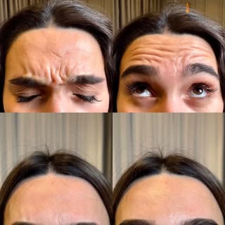 3 bölge botoks sonucu...