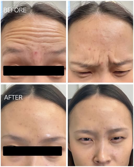 A little Botox. A softer look. ✨

Smoother forehead lines and softened frown lines—small changes tha