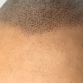 Si estás dudando en hacerte la micropigmentación capilar, mirá este video 👀

Un tratamiento sin cir