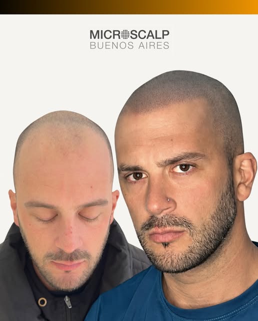 Definición, naturalidad y un look rapado que se adapta a vos. La micropigmentación capilar ayuda a r