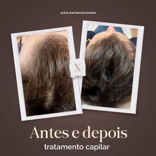 A perda de cabelo afeta tanto homens quanto mulheres, impactando não apenas a aparência, mas também 