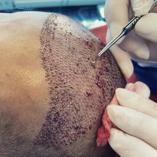 Augmentation capillaire #greffedecheveux #greffedecheveuxturquie #greffecapillaire #greffedecheveuxi