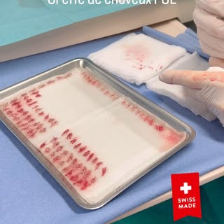 Transplantation capillaire FUE effectuée sous anesthésie locale dans l'un de nos blocs opératoires #
