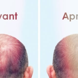 Greffe de cheveux a Genève