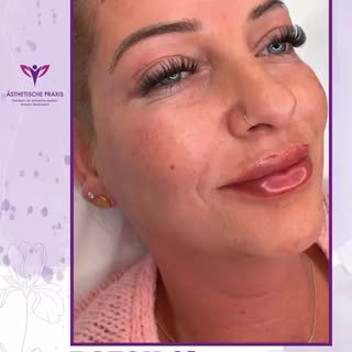 Botox® 3 Zonen in Köln & Hamburg – Behandlung von Mimikfalten 

Du möchtest Stirnfalten, Zornesfalte