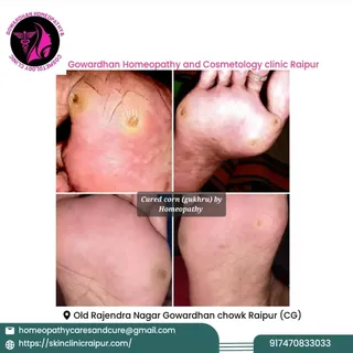 Corn treatment without surgery